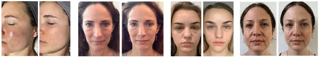 massaggio kobido prima e dopo